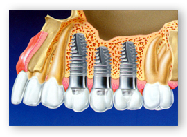 Dental İmplant Nedir